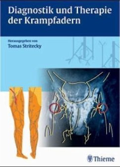 Chirurgie der Krampfadern