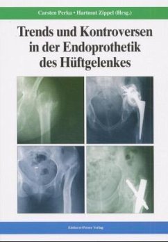 Trend und Kontroversen in der Endoprothetik des Hüftgelenkes