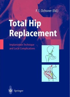 Total Hip Replacement - Ochsner, P.E. (ed.)