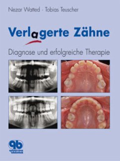 Cover Verlagerte Zähne