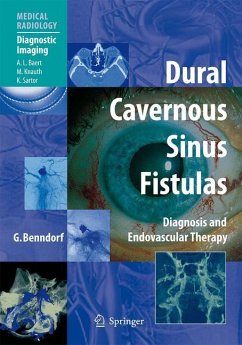 Dural Cavernous Sinus Fistulas - Benndorf, Goetz