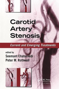 Carotid Artery Stenosis - Rothwell, Peter M. (ed.)