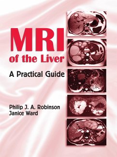 MRI of the Liver - Robinson, Philip J a; Ward, Janice