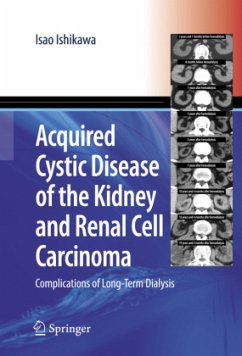 Acquired Cystic Disease of the Kidney and Renal Cell Carcinoma - Ishikawa, Isao