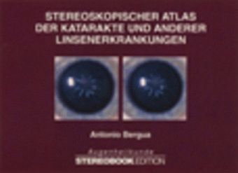 Stereoskopischer Atlas der Katarakte und anderer Linsenerkrankungen, m. Stereobrille Stereoskopischer Atlas der Katarakte und anderer Linsenerkrankungen, m. Stereobrille