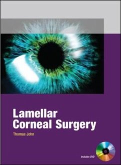 Lamellar Corneal Surgery - John, Thomas