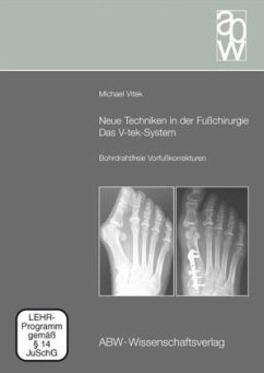 Neue Techniken in der Fußchirurgie - Das V-tek-System, m. DVD - Vitek, Michael