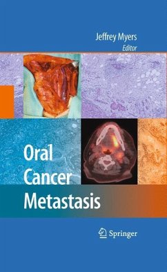 Oral Cancer Metastasis