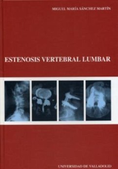 Estenosis vertebral lumbar - Sánchez Martín, Miguel María