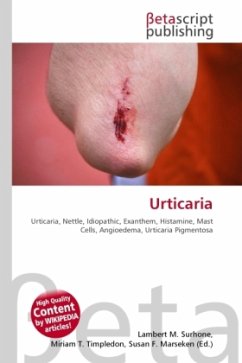 Urticaria