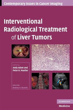 Interventional Radiological Treatment of Liver Tumors