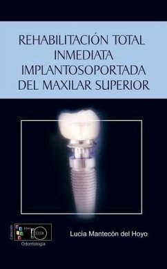 Rehabilitación total inmediata implantosoportada del maxilar superior: técnicas de carga inmediata