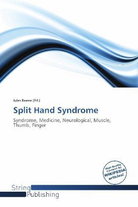 Split Hand Syndrome Split Hand Syndrome