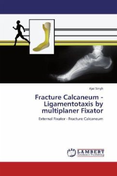 Fracture Calcaneum - Ligamentotaxis by multiplaner Fixator