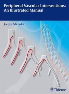 Peripheral Vascular Interventions: An Illustrated Manual - Schröder, Jürgen