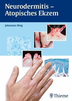Neurodermitis - Atopisches Ekzem (eBook, PDF) - Ring, Johannes