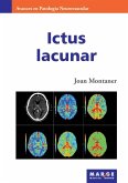 Ictus lacunar Ictus lacunar