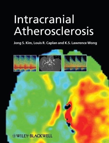 Intracranial Atherosclerosis (eBook, PDF) Intracranial Atherosclerosis (eBook, PDF)