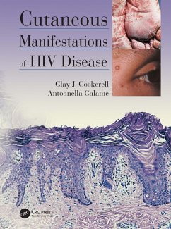 Cutaneous Manifestations of HIV Disease (eBook, PDF) - Cockerell, Clay; Calame, Antoanella