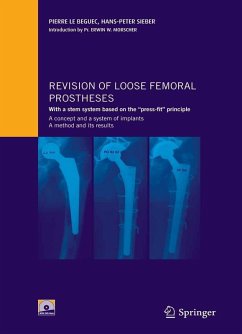 Revision of loose femoral prostheses with a stem system based on the 