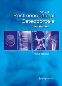 Cover Atlas of Postmenopausal Osteoporosis (eBook, PDF)