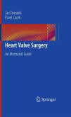 Heart Valve Surgery (eBook, PDF)