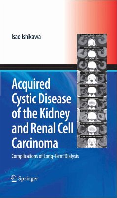 Acquired Cystic Disease of the Kidney and Renal Cell Carcinoma (eBook, PDF) - Ishikawa, Isao