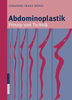 Abdominoplastik (eBook, PDF) - Hönig, Johannes-Franz