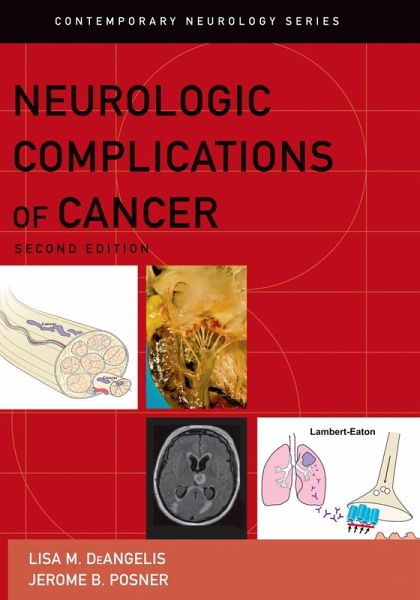 Neurologic Complications of Cancer (eBook, PDF)