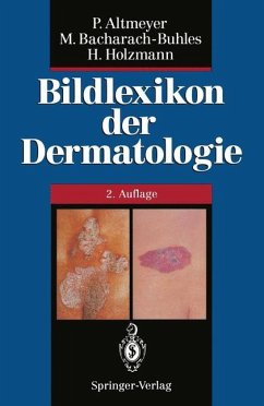 Bildlexikon der Dermatologie - Altmeyer, Peter;Bacharach-Buhles, Martina;Holzmann, Hans