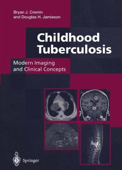 Childhood Tuberculosis: Modern Imaging and Clinical Concepts - Cremin, Bryan J.;Jamieson, Douglas H.