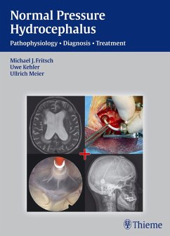 Normal Pressure Hydrocephalus (eBook, PDF) - Fritsch, Michael J.; Meier, Ullrich; Kehler, Uwe