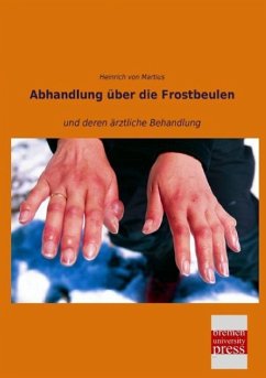 Abhandlung über die Frostbeulen - Martius, Heinrich