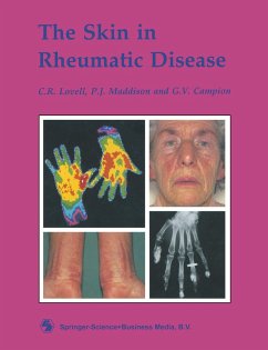 The Skin in Rheumatic Disease - Lovell, C. R.;Campion, G. V.;Maddison, P. J.