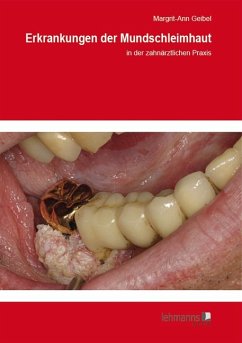 Erkrankungen der Mundschleimhaut (eBook, PDF) - Geibel, Margrit-Ann