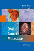 Oral Cancer Metastasis