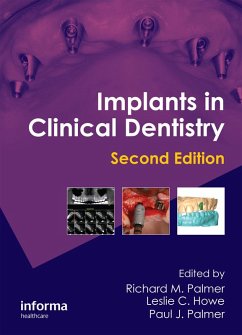 Cover Implants in Clinical Dentistry (eBook, PDF)