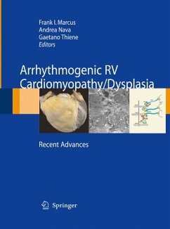 Arrhythmogenic RV Cardiomyopathy/Dysplasia