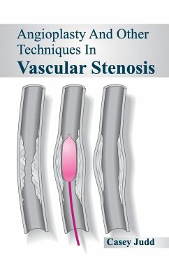 Angioplasty and Other Techniques in Vascular Stenosis