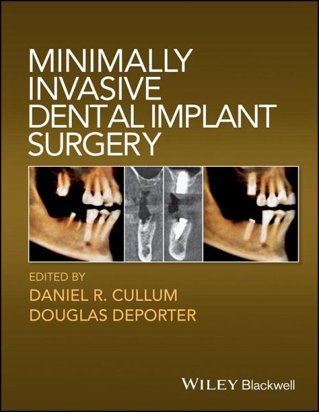 Minimally Invasive Dental Implant Surgery (eBook, ePUB)