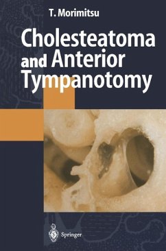 Cholesteatoma and Anterior Tympanotomy (eBook, PDF) - Morimitsu, Tamotsu