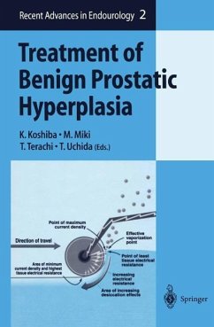 Cover Treatment of Benign Prostatic Hyperplasia (eBook, PDF)