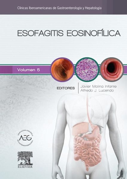 Esofagitis eosinofílica (eBook, ePUB) Esofagitis eosinofílica (eBook, ePUB)
