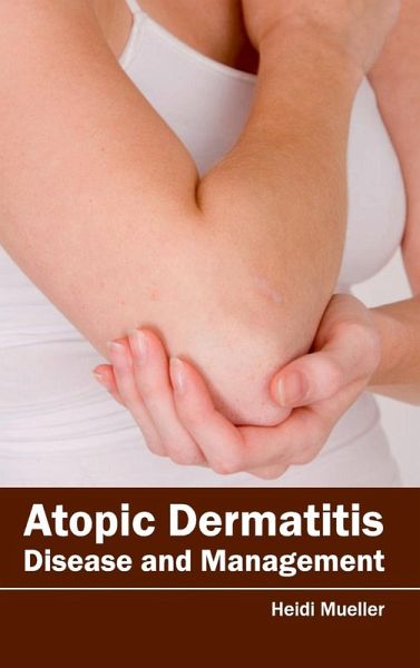 Atopic Dermatitis Atopic Dermatitis