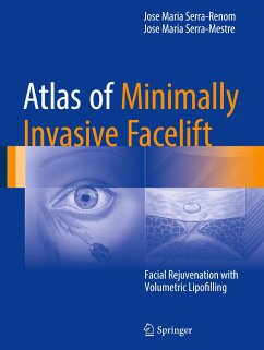 Atlas of Minimally Invasive Facelift - Serra-Renom, Jose Maria;Serra-Mestre, Jose Maria