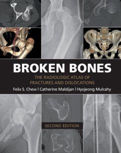 Broken Bones (eBook, PDF) - Chew, Felix S.