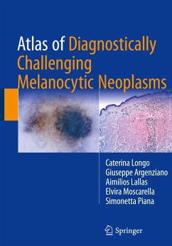 Atlas of Diagnostically Challenging Melanocytic Neoplasms - Longo, Caterina;Argenziano, Giuseppe;Lallas, Aimilios