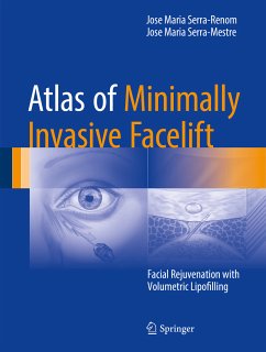 Atlas of Minimally Invasive Facelift (eBook, PDF) - Serra-Renom, Jose Maria; Serra-Mestre, Jose Maria
