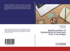 Severity analysis of Osteoarthritis of knee joint from X-ray images - Kawathekar, Pooja;Kadam, Sneha;Karande, Kailash