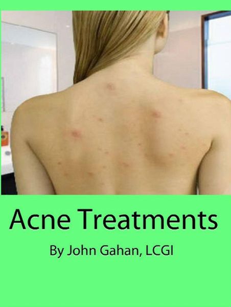 Acne Treatments (eBook, ePUB) Acne Treatments (eBook, ePUB)